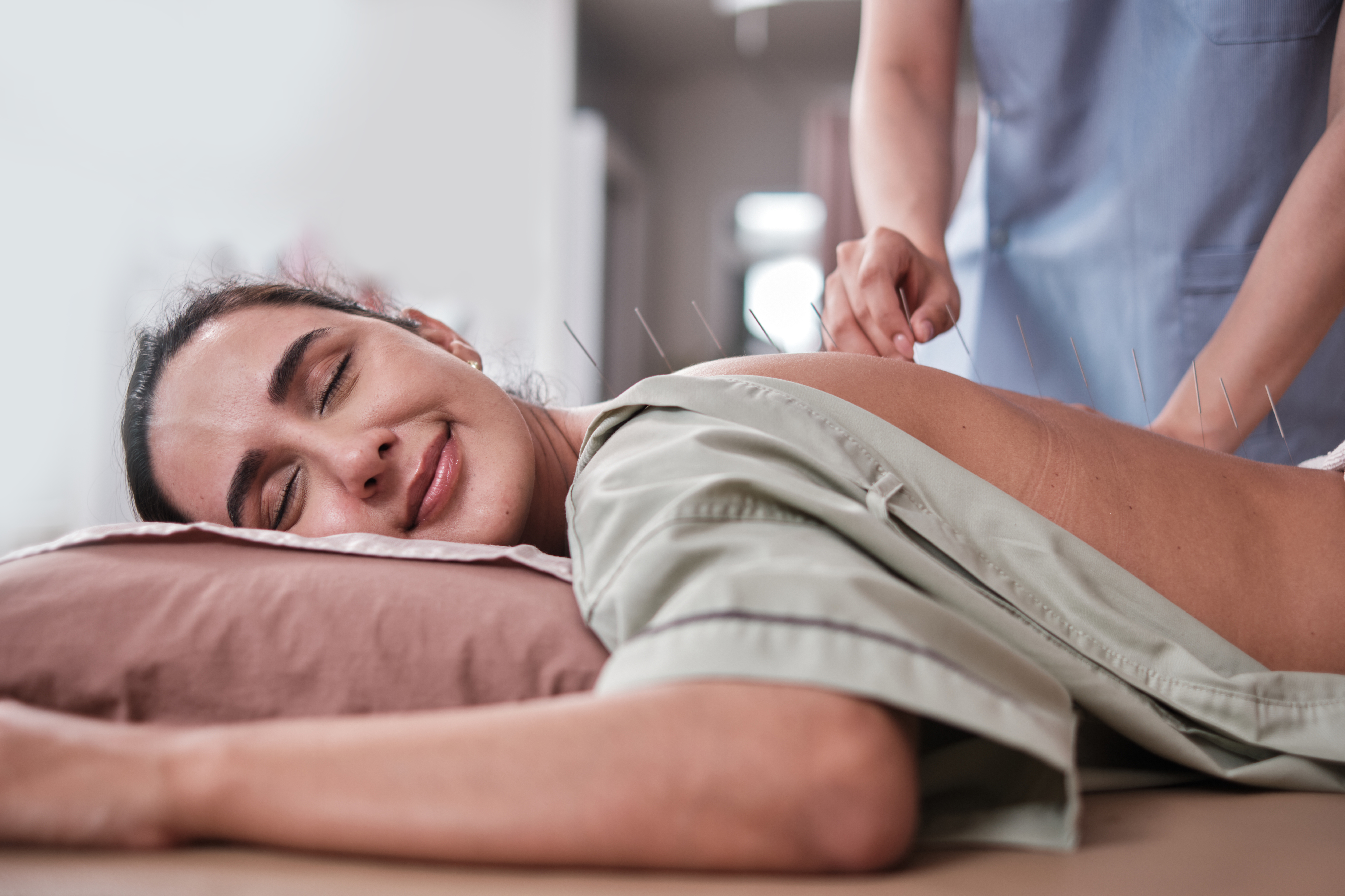 a latin woman with acupuncture treatment on her ba 25b87223ed9d269dc07c