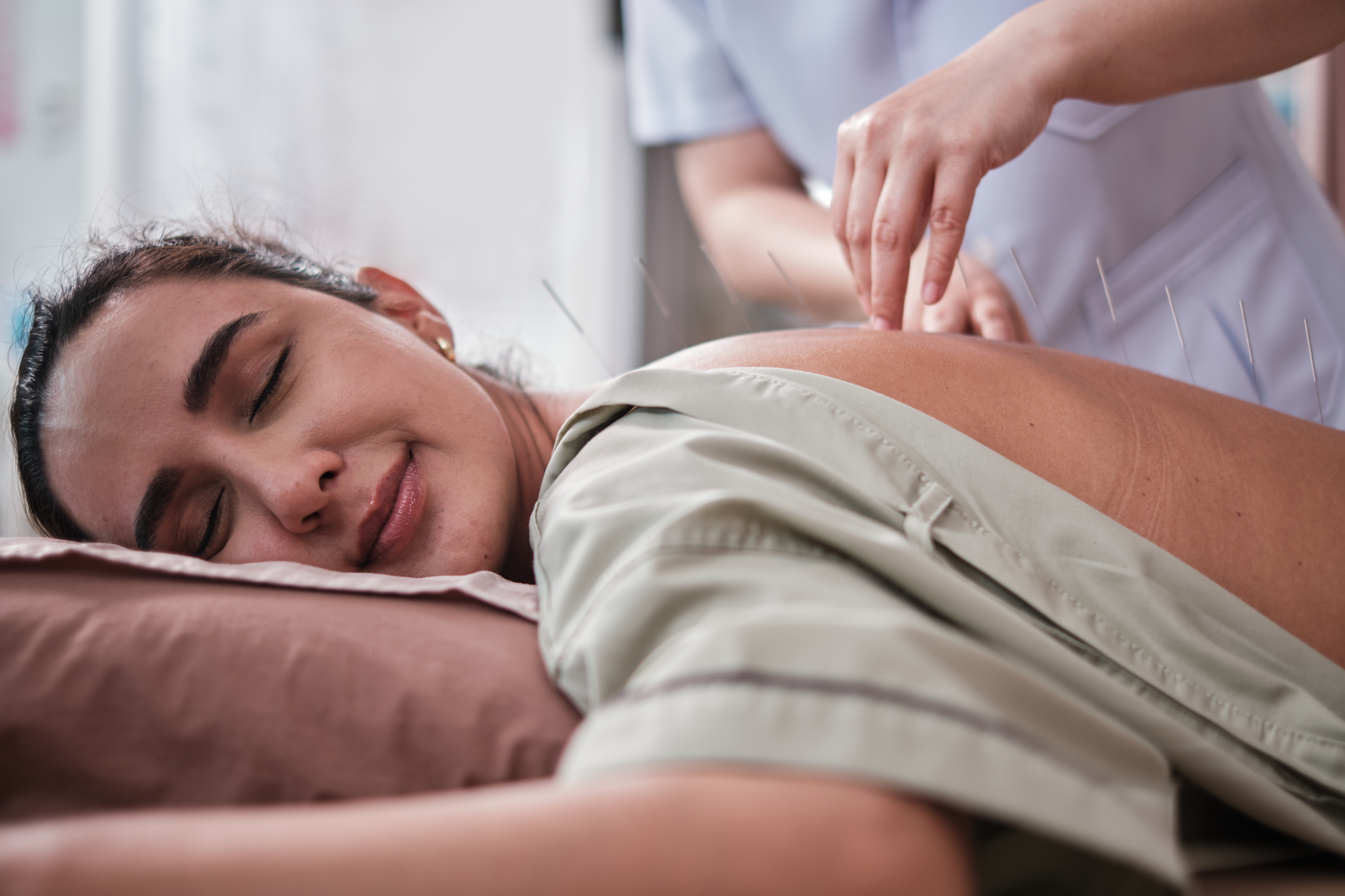 a latin woman with acupuncture treatment on her ba b360fe2aa0b3ae02e67c