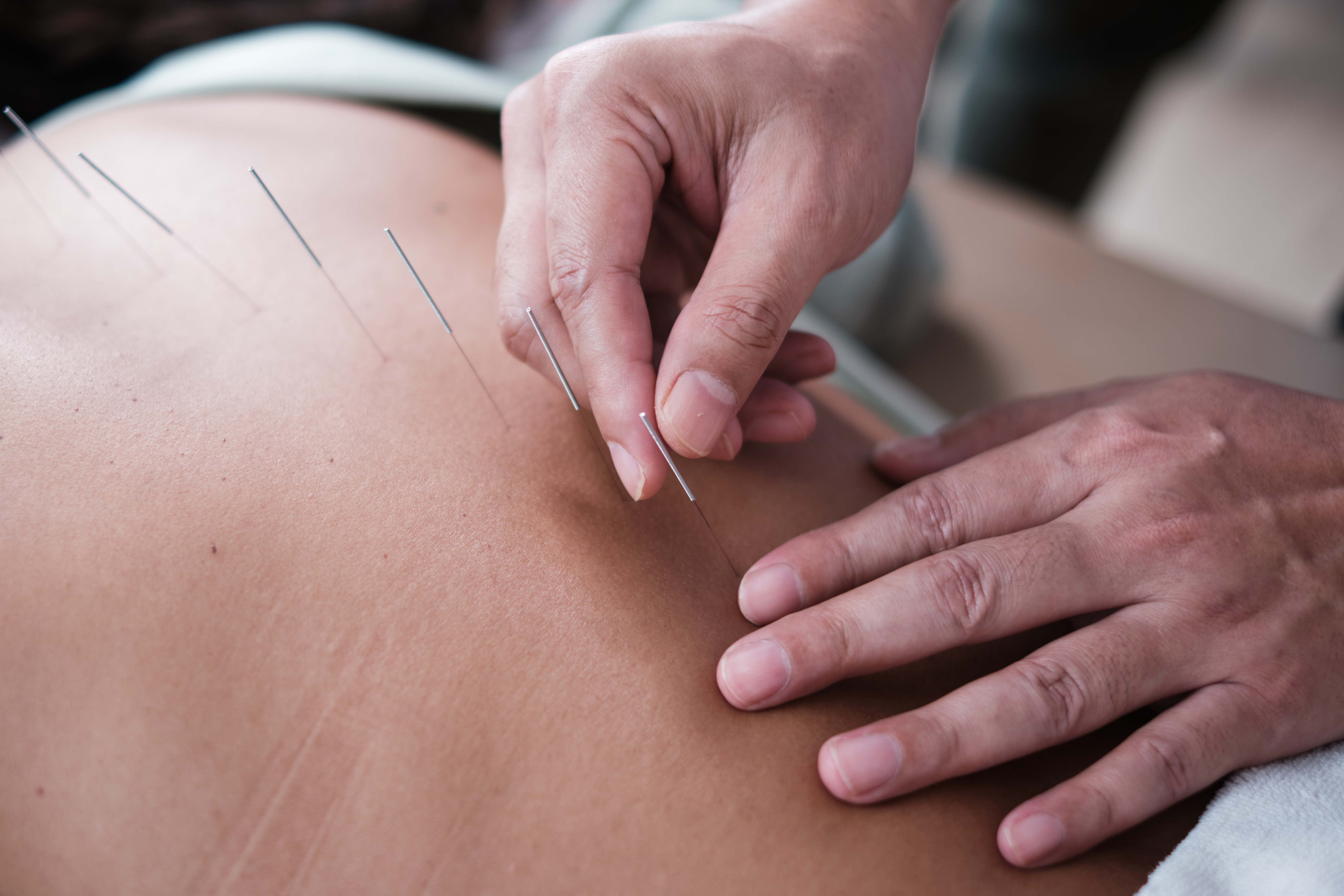 close up shot of an acupuncture procedure for back 4142514d7b0fc91f1b55