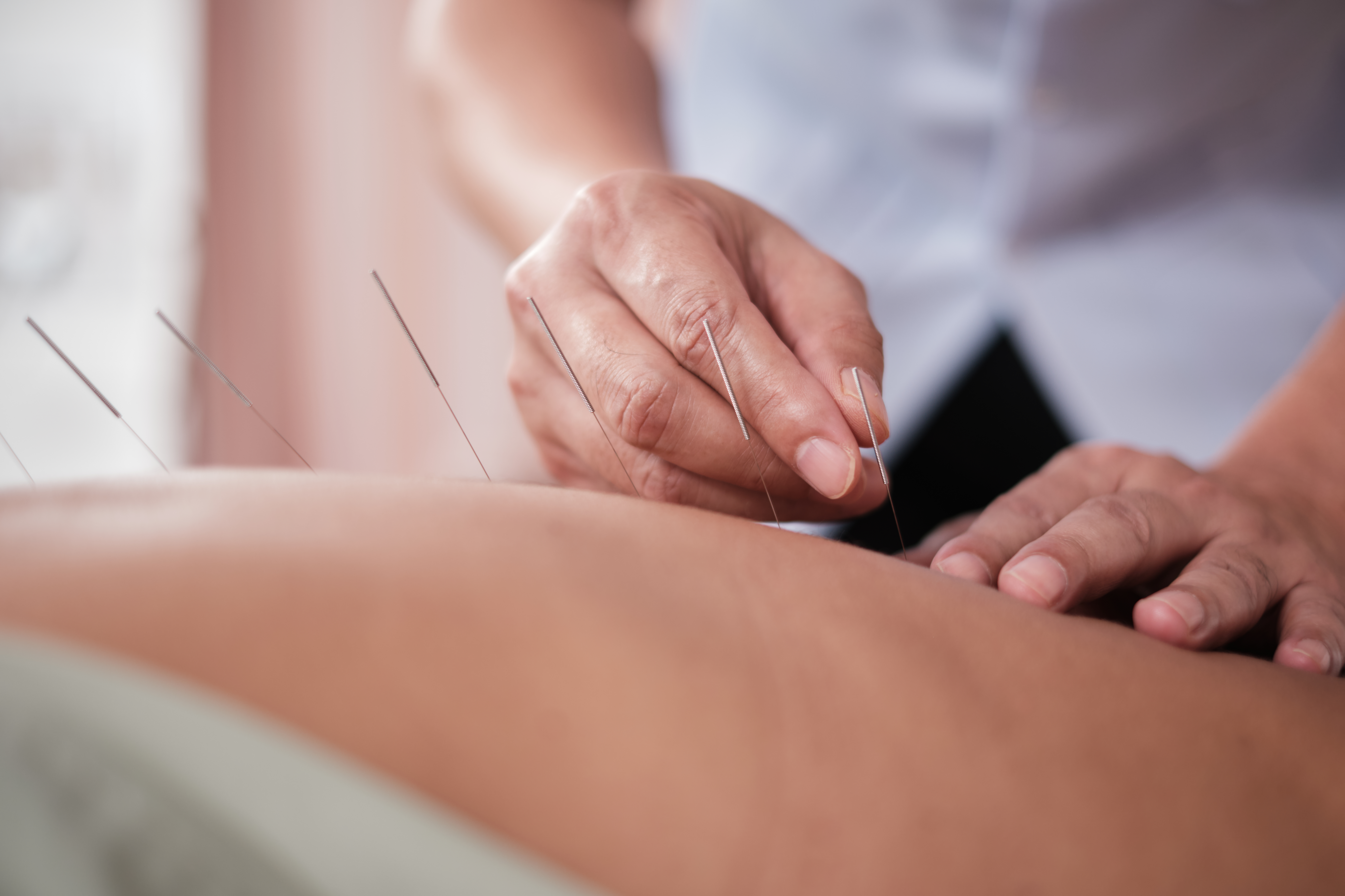 close up shot of an acupuncture procedure for back c3fe16e61d590dd96c0f