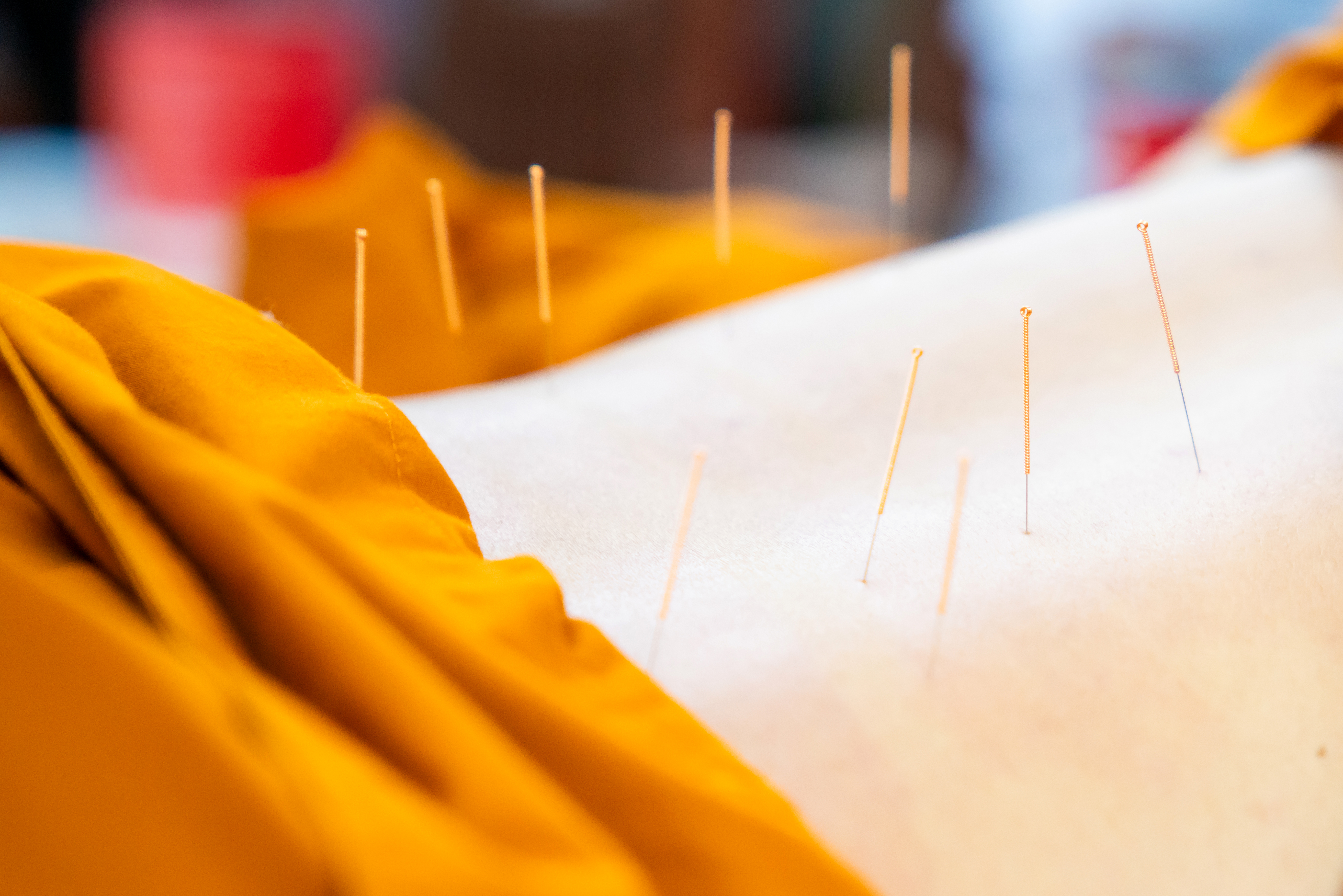 doctor sticks needles into the human body on the a 25ec1945dec99faea973