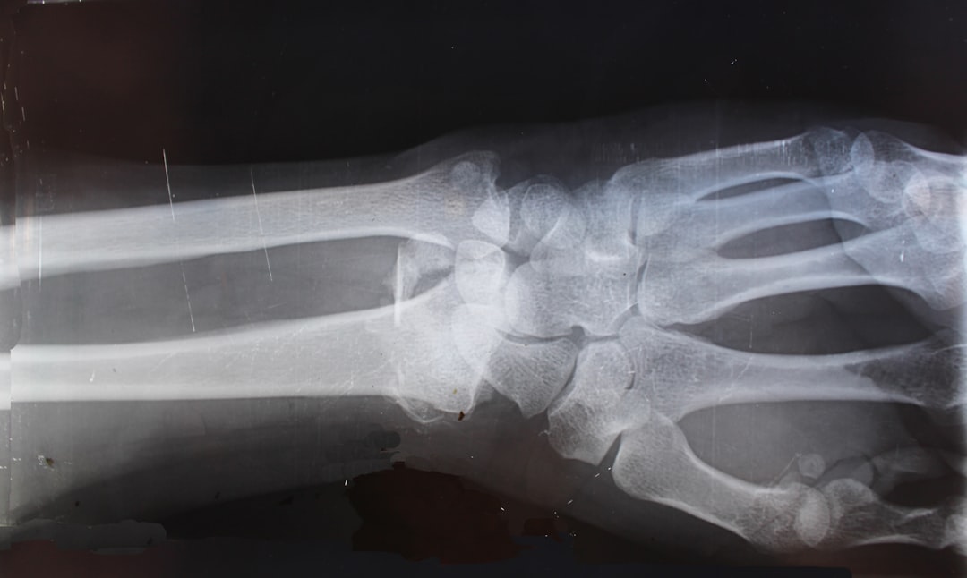 Restoring Function and Confidence after Hand and Wrist fractures